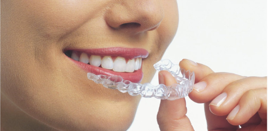 clear aligner teeth straightening treatment